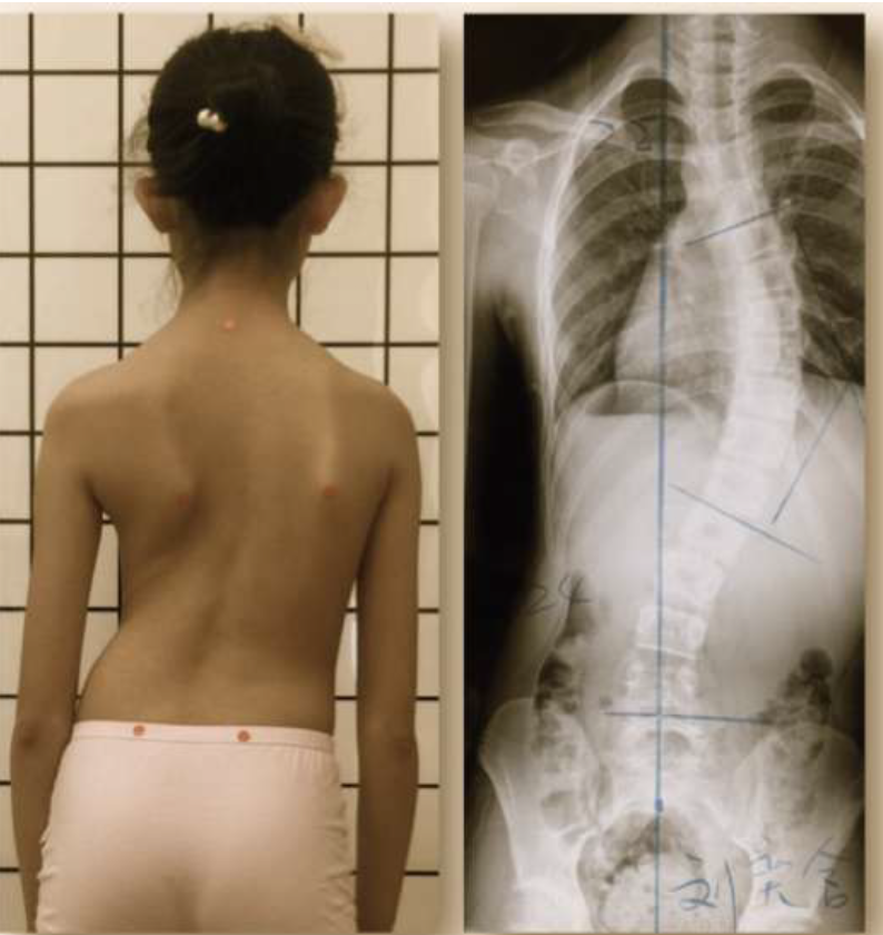 scoliosis bracing with the Gensingen brace