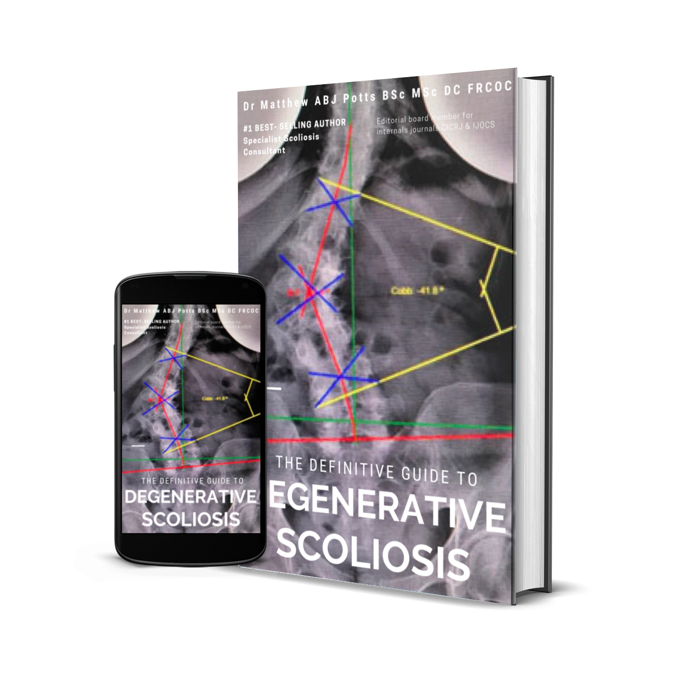 scoliosis brace indirect scoliosis.co.uk